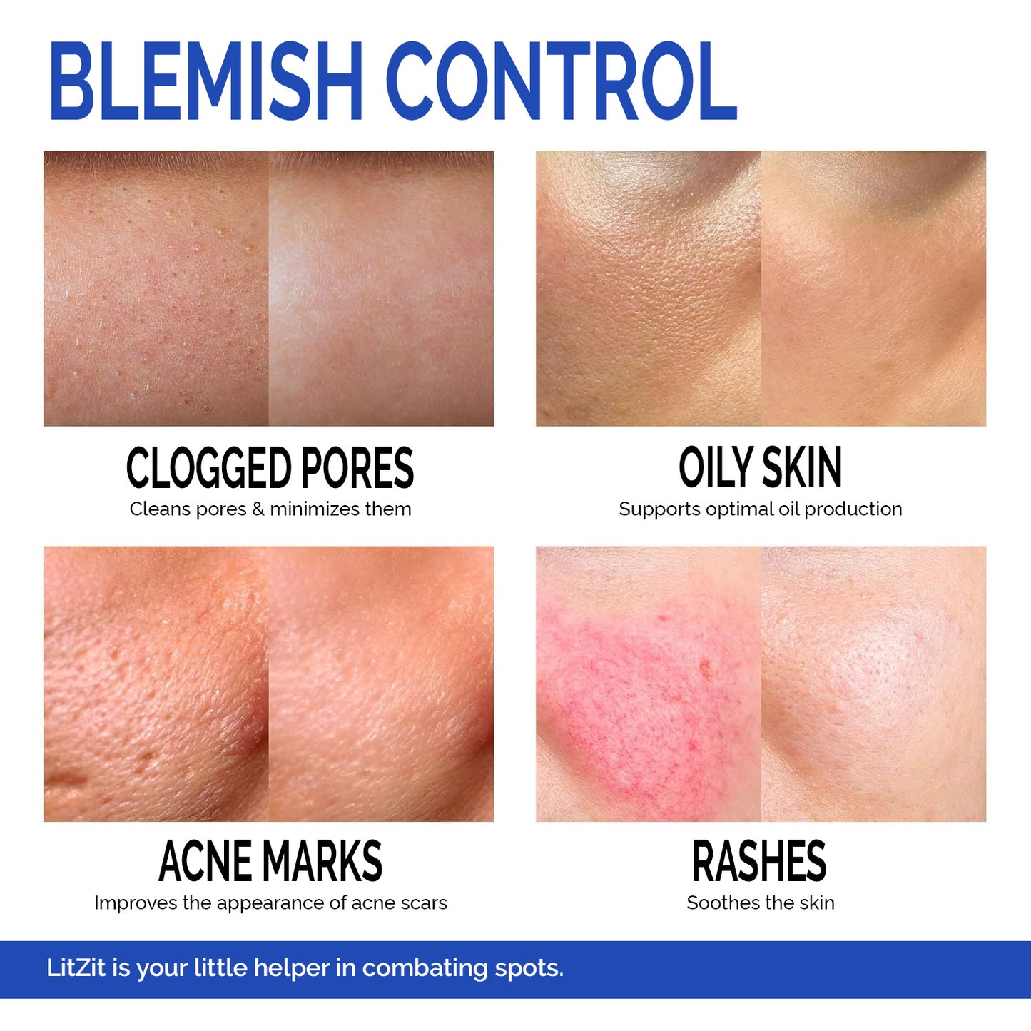 LIT ZIT Acne Treatment Cream