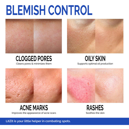 LIT ZIT Acne Treatment Cream